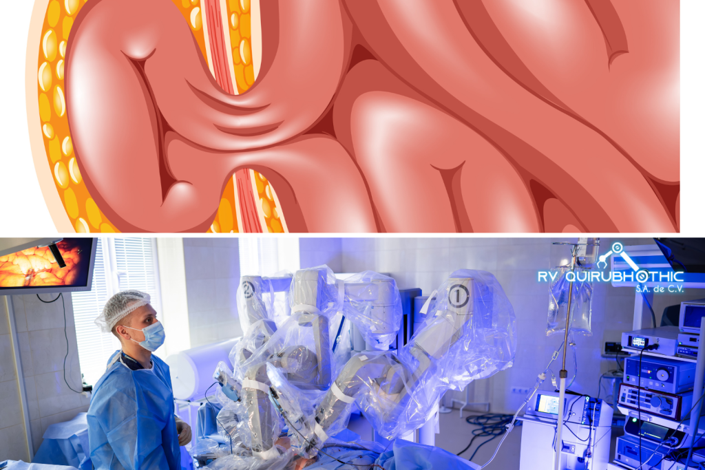 Reparación Robótica de Hernias - Quirubhothic 