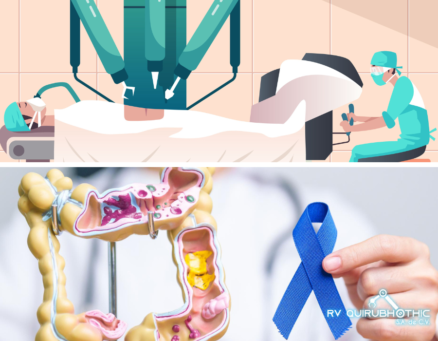 Optimización del tratamiento del cáncer de colon a través de la Cirugía Robótica - Quirubhothic